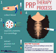 Hair loss treatment in malaysia. Platelet Rich Plasma In Malaysia Prp Malaysia