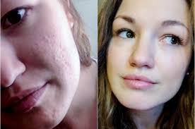 Micro Needling Everything You Ever Wanted To Know Bold Blush Microneedling Derma Rolling Anti Aging Skin Treatment