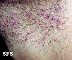 Holding the penis up allows you to shave the lower part. Ingrown Hair Prevention Infection Scars Pictures Cure Removal Ehealthstar