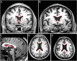 Image result for Ctenium somalense