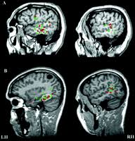 épilepsie.temporale