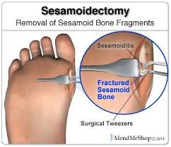 The Sesamoid Bones Are Accessed Through An Incision On The Side Of The Foot Sesamoiditis Sesamoid Bone Tendonitis Foot Plantar Fasciitis Remedies
