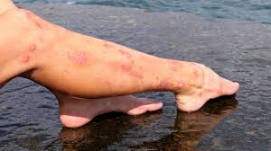 Can someone tell me how to remove only part of the patches? How To Remove Scars On Legs Permanently Here Are 13 Effective Ways