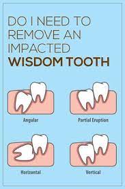 An Impacted Wisdom Tooth Takes Place When Your Wisdom Teeth Grow At An Awkward Angle Or If There Is Not Enough Room F Wisdom Teeth Impacted Wisdom Teeth Teeth