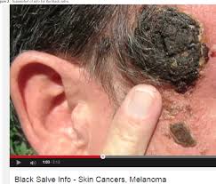 01.08.2019 · in this video, i explain and differentiate the three main types of skin cancers: Pdf Youtube Videos Related To Skin Cancer A Missed Opportunity For Cancer Prevention And Control Semantic Scholar