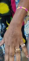 Image result for Photodermatitis