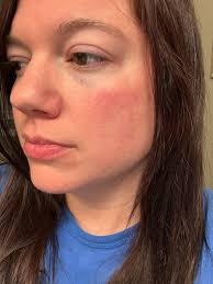 For the first time I have COVID. 5 years after pandemic and NOW I get  COVID..lol. I have EDS and a host of conditions with it. Are there any  things after you