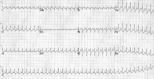 Supraventricular tachycardia (svt) is a fast heart rhythm arising from abnormal electrical activity in the upper part of the heart. Supraventricular Tachycardia Svt Litfl Ecg Library Diagnosis