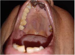 Image result for Oral herpes roof of mouth