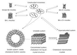 Concept Of The Pathogenesis And Treatment Of Cholelithiasis