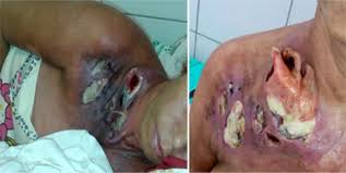 About one per 62,500 males are affected per year. Scielo Brasil Case Report Treatment Of Fournier S Gangrene Of The Shoulder Girdle Case Report Treatment Of Fournier S Gangrene Of The Shoulder Girdle