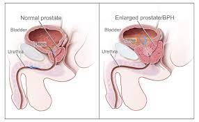 prostate cancer is the second most common kind of cancer men get. Prostate Cancer Prevention Pdq Patient Version National Cancer Institute