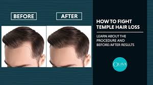 Keratin treatments for hair generally include the application of extra keratin extracted from animal products like wool and chicken feathers. Temple Hair Loss Does Prp Treatment Really Work For Hair Regrowth Youtube