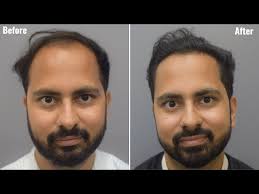 Life-Changing Hair Transplant Journey: My Transformation Story"
