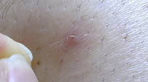 The bump will look like a pimple and will be itchy, and can leave a dark spot in your groin area. Infected Ingrown Hair Pictures Treatment Removal And More
