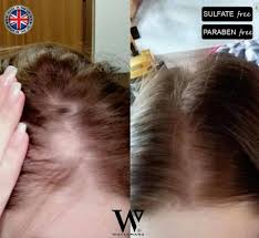 (there are before & after p. Best Hair Growth Shampoo Conditioner Australia Watermans Hair Growth Australia Watermans Au