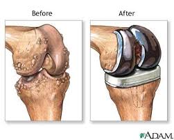 How Rheumatoid Arthritis Affects Each Part Of The Body Total Knee Replacement Knee Replacement Knee Replacement Surgery