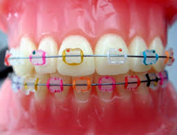 Black And Light Blue Braces Showing The Different Color Options Paired With Ceramic Brackets Braces Colors Teeth Braces Ceramic Braces