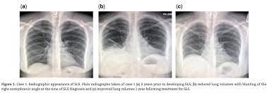 Nick Mark Md On Twitter The Prognosis Of Shrinking Lung Syndrome Sls Is Good Most Patients Respond Favorably To A Course Of Glucocorticoids Typically 40 60mg Prednisone Daily With Lung Function Imaging