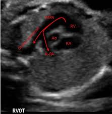 Pin By Hillary Boyd On Ultrasound In 2020 Ultrasound Diagnostic Medical Sonography Echocardiogram