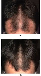 Hair grows about a half inch per month on average, so you should let your hair grow for about three months before you trim it, says kyle. Male Androgenetic Alopecia Endotext Ncbi Bookshelf