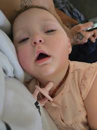 Autistic child sleeping with eyes open?