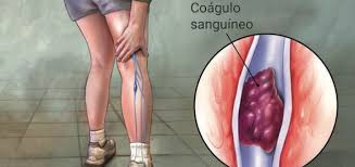 Trombose: saiba o que é e como identificar os sintomas - Duclin Análises  Clínicas