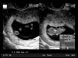 Ssw bereits die gesichtszüge deines babys erkennen. 11 Ssw 11 Schwangerschaftswoche Grosse Entwicklung 9monate De