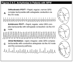 Avnrt occurs when a reentrant circuit is present within the av node. Special Feature The Electrocardiogram In Wolff Parkinson White Syndrome Part Ii The Arrhythmias 2003 03 01 Ahc Media Continuing Medical Education Publishing