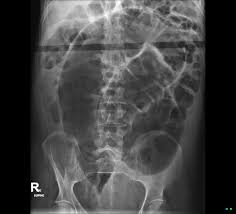 Image result for Sigmoid Volvulus