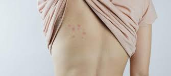 Image result for bedbug bites look like