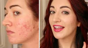 cover acne scars without aggravating skin
