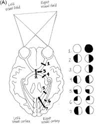 Image result for Visual Field Deficit