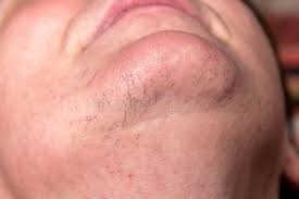 7 causes of facial hair in women and possible remedies. Hairs On Chin Hair Removal On Face Stock Photo Image Of Caucasian Chin 173193850