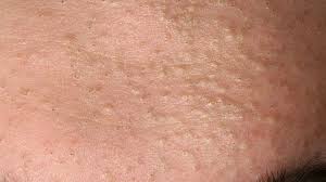 It has a drying effect that is effective at removing excess oils. Comedonal Acne Traditional Treatments Natural Remedies And More