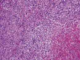 The images of body positron emission tomography revealed irregular, left pleural thickening involving mediastinal and diaphragmatic surfaces with hypermetabolic characterization. Sarcomatoid Malignant Mesothelioma Thoracic Pathology A Volume In The High Yield Pathology Series Expert Consult Online And Print 1st Edition