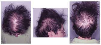 Diffuse thinning is a presentation of hair loss caused by androgenic alopecia, stress, or chronic conditions. 57 Y Old Female Patient With Diffuse Hair Loss And A Moderate Elevated Download Scientific Diagram