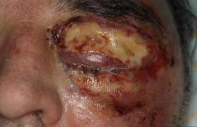 From a practical standpoint, necrotizing fasciitis can be divided into a few types. Necrotizing Fasciitis Ophthalmology