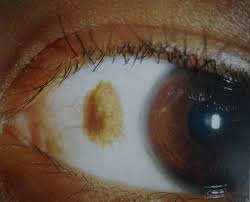 Image result for melanosis sclera