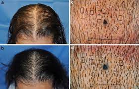 How does laser therapy (lllt) work? 7 Things You Should Know Before You Buy A Laser Helmet Cap Or Comb