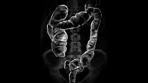 Image result for Virtual Colonoscopy