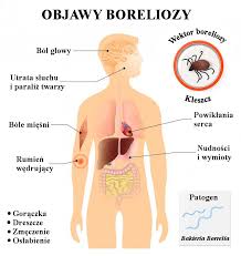 Objawy choroby z lyme są zróżnicowane, a niektóre z nich są podobne do innych chorób. Borrelia Bakteria Ktora Mozesz Pokonac Z Biobalance