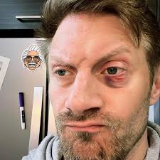 Got popped Friday morning doing Bjj! Thank goodness i have Cherry to make  it right! 🤼‍♂️🤼‍♂️🤼‍♂️🎤🎤🎤