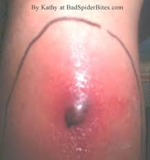Pin On Spider Bites Pictures