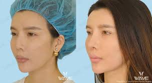 Surgery + hotel + visa transfer + interpreter. Asian Rhinoplasty In Los Angeles Wave Plastic Surgery