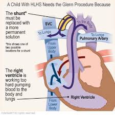 Hypoplastic Left Heart Syndrome Surgery The Glenn Procedure For Parents Nemours Kidshealth In 2020 Surgery Syndrome Norwood Procedure