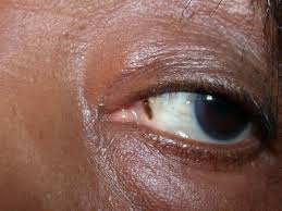 Image result for conjunctival melanoma