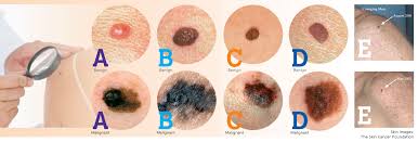 Skin cancer is by far the most common type of cancer. Skin Cancer Protection And Early Detection Are Key Cayman Health