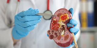 Image result for Fecal Transfer