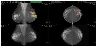 Image result for Mammogram Interpretation